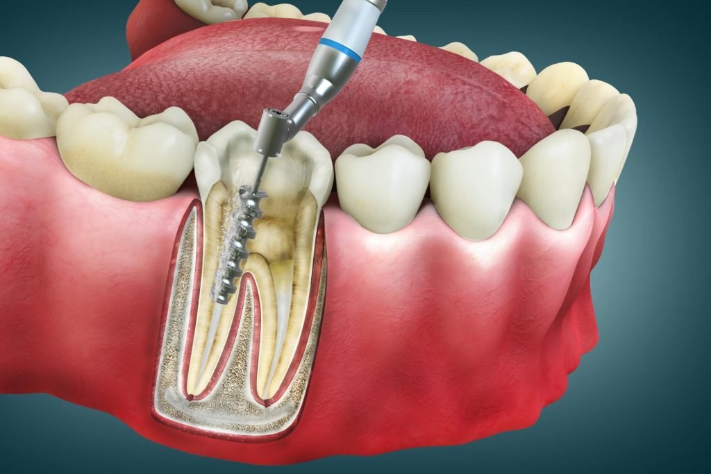 Root Canal Treatment: