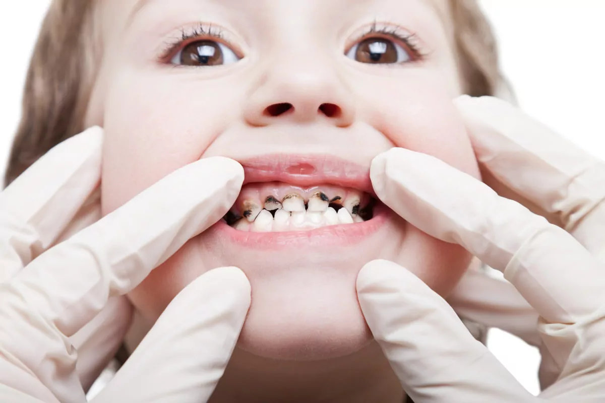 Dental Issues in Children