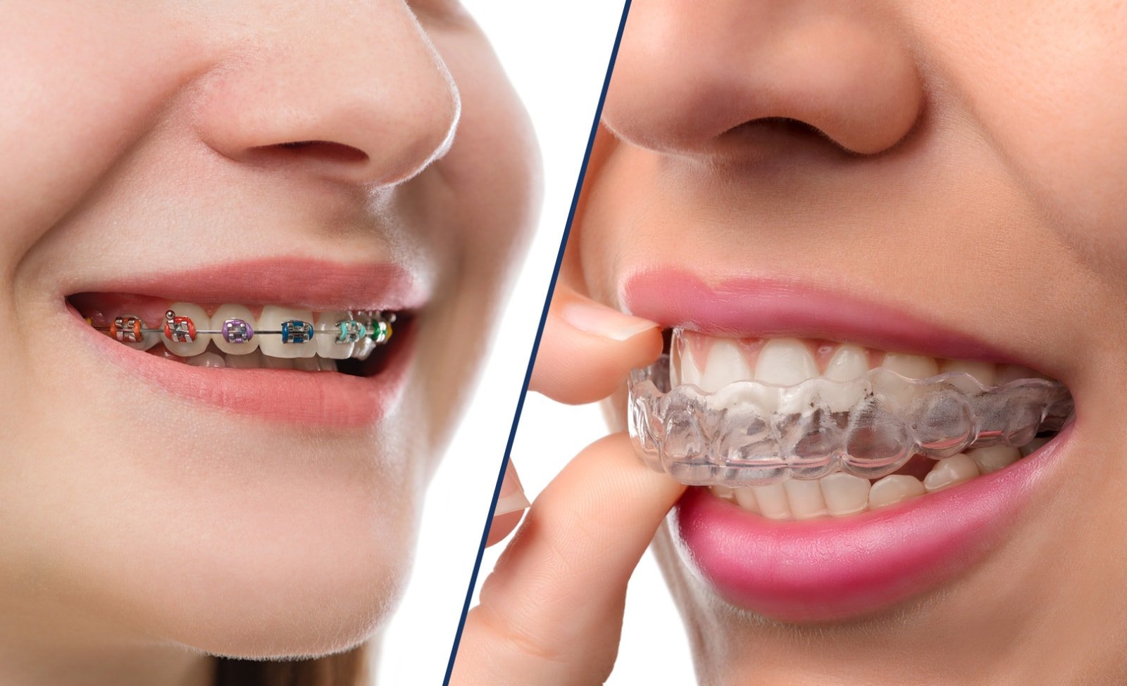 braces vs invisalign