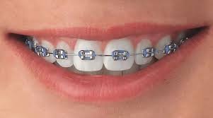 braces