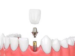 dental implants