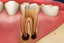 Root Canal Treatment